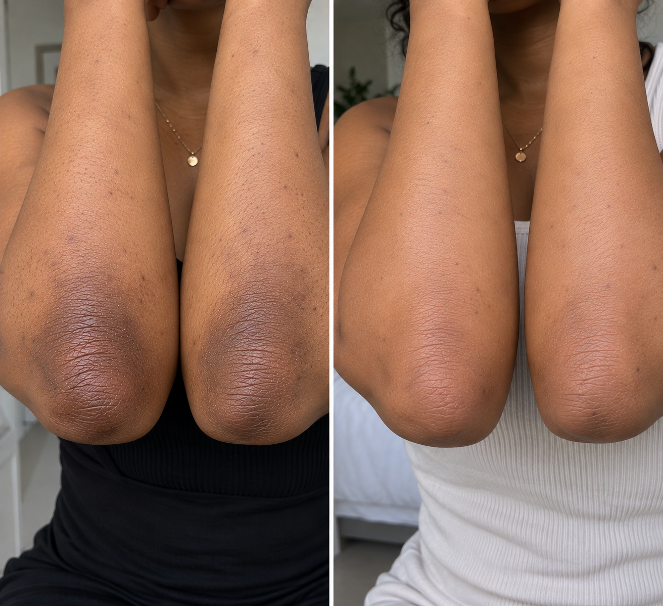 Before and after elbow skincare result
